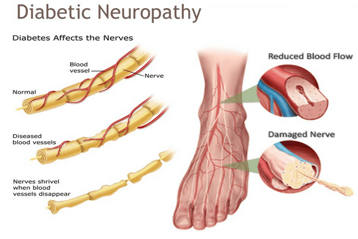 Fox Integrated Health - Health and Wellness Blog - Diabetic Neuropathy and Chiropractic Care