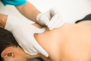 The Science Behind Dry Needling